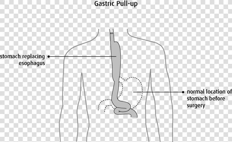 Esophageal Cancer Gastric Pull Up  HD Png DownloadTransparent PNG