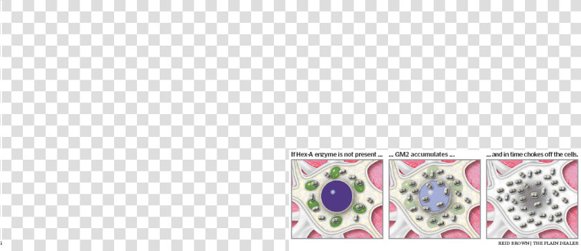 Cell  Disease  En  Nerve  Sachs   Png Download   Tay Sachs Disease  Transparent PngTransparent PNG