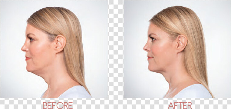 Chin Fat Removal  HD Png DownloadTransparent PNG