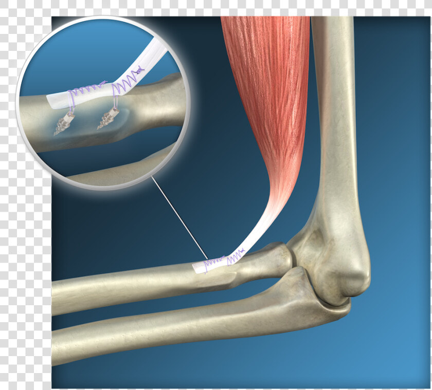 Endoscopic Distal Biceps Reinsertion Surgery  Toulouse   Ruptura Distal Del Biceps  HD Png DownloadTransparent PNG