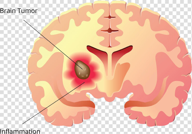 Brain Tumor Label   Brain Tumor Clipart  HD Png DownloadTransparent PNG