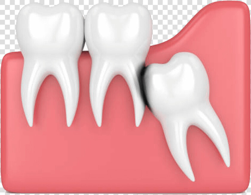 Wisdom Teeth  HD Png DownloadTransparent PNG