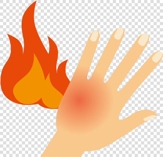 Skin Clipart Burned Food   Burned Hand Clipart  HD Png DownloadTransparent PNG