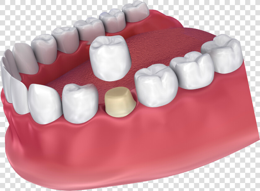 How A Dental Crown Fits   Crown Dental  HD Png DownloadTransparent PNG