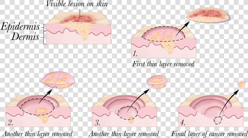 © 2010 Terese Winslow   Skin Cancer Treatment  HD Png DownloadTransparent PNG