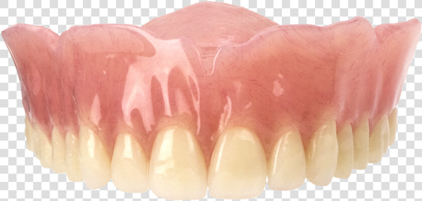 Bonded Case   Aspen Dental Upper Dentures  HD Png DownloadTransparent PNG