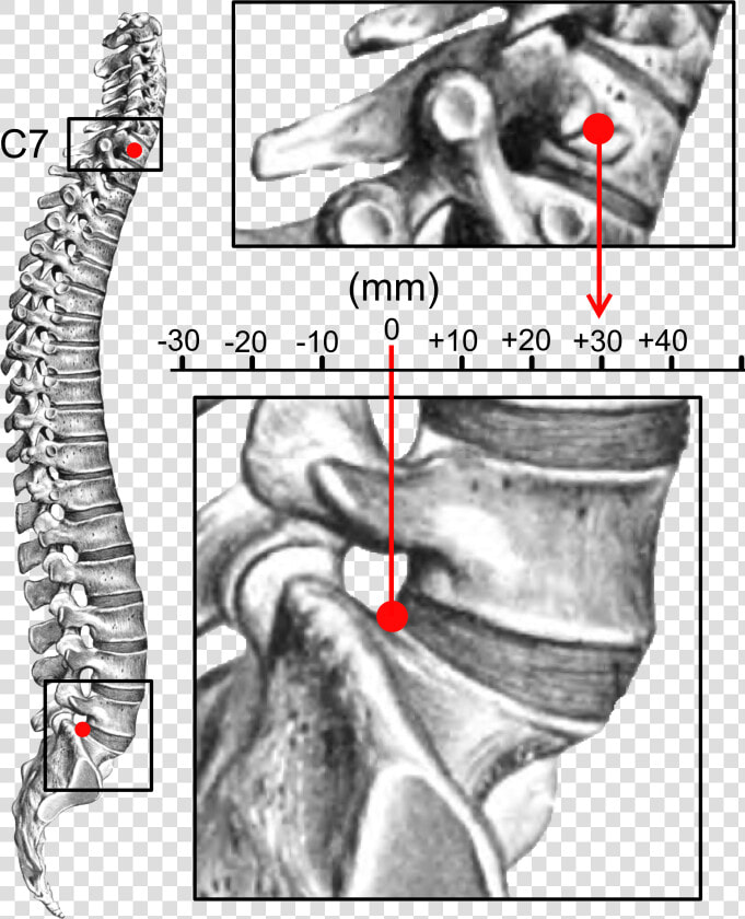 Sagittal Balance   Kyphosis  HD Png DownloadTransparent PNG