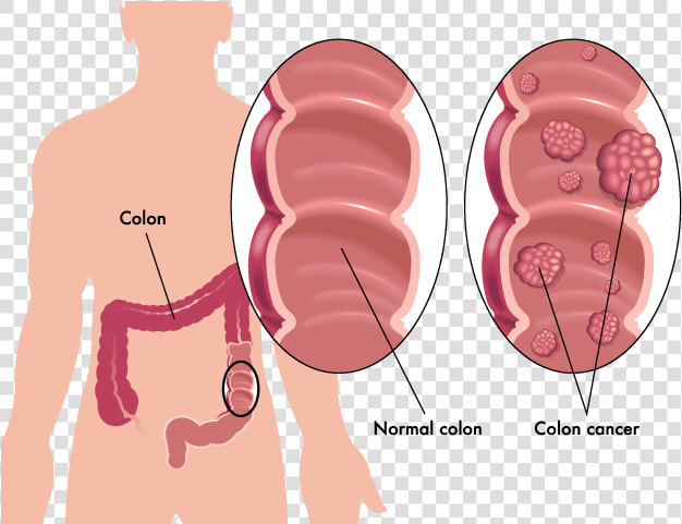 Colon Cancer Tumors   Colon Cancer Vs Healthy Colon  HD Png DownloadTransparent PNG