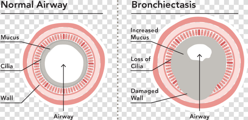 Bronchiectasis Loss Of Cilia  HD Png DownloadTransparent PNG