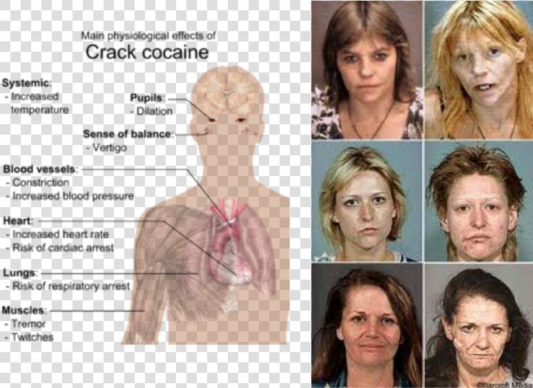 Picture   Effects Of Crack Cocaine  HD Png DownloadTransparent PNG