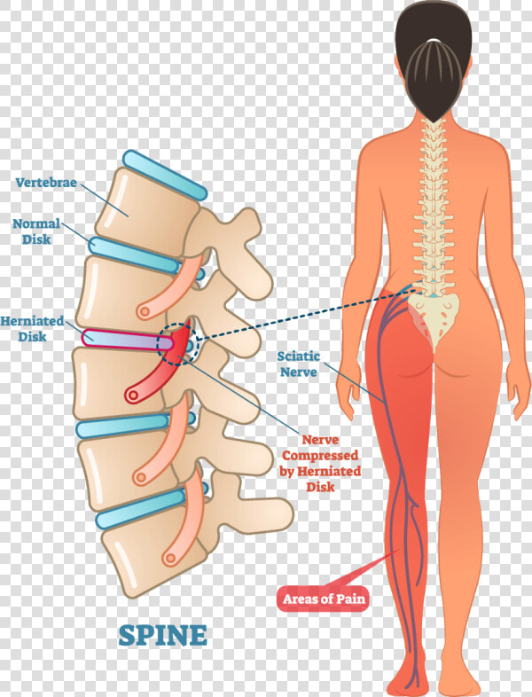 Left Side Sciatic Nerve Pain  HD Png DownloadTransparent PNG