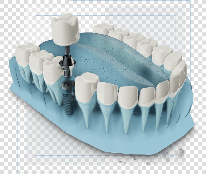 Dental Implants Graphic   Dental Implant  HD Png DownloadTransparent PNG