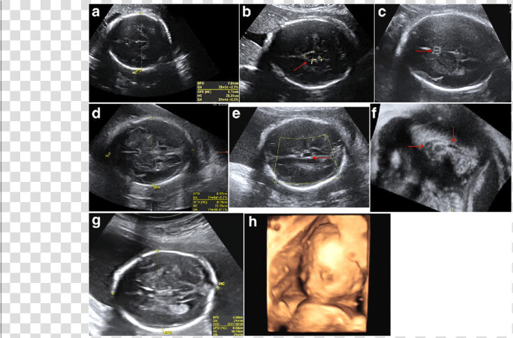 Bpd On An Ultrasound  HD Png DownloadTransparent PNG