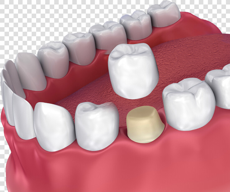 Dental Crown Hovering Over Prepared Tooth   Crown Dental  HD Png DownloadTransparent PNG