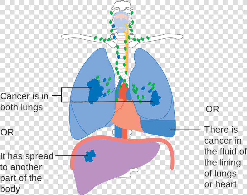 Stage 4 Lung Cancer Diagram  HD Png DownloadTransparent PNG