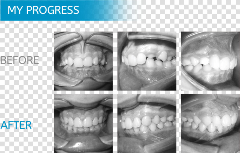 Midwest Orthodontics Chicago   Teeth Xray Before And After Braces  HD Png DownloadTransparent PNG