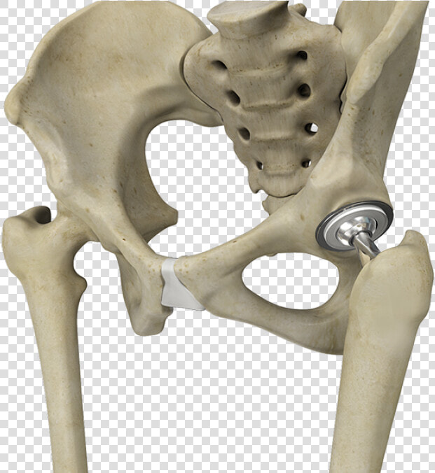 Artificial Hip Joint   Total Hip Replacement Png  Transparent PngTransparent PNG