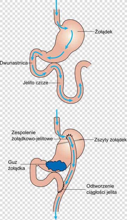 Diagram Showing Before And After Stomach Bypass Surgery  HD Png DownloadTransparent PNG