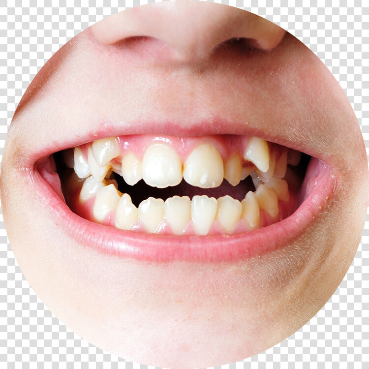 Do Teeth Grow Crooked   Irregular Teeth  HD Png DownloadTransparent PNG