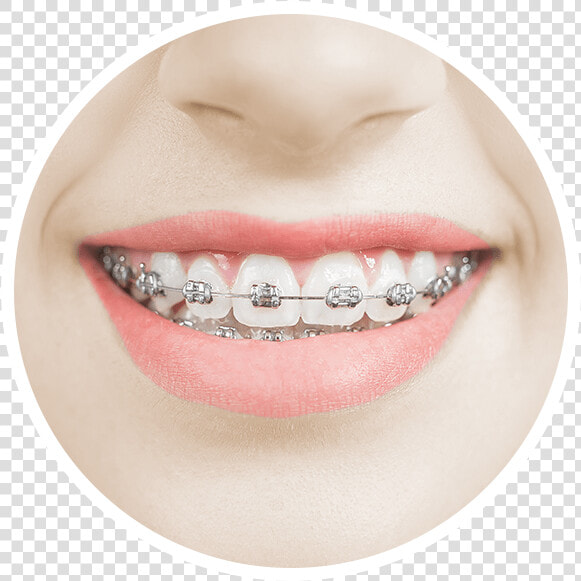 A Woman Smiles Happily With Metal Braces On Her Increasingly   Smiles With Gold Braces  HD Png DownloadTransparent PNG