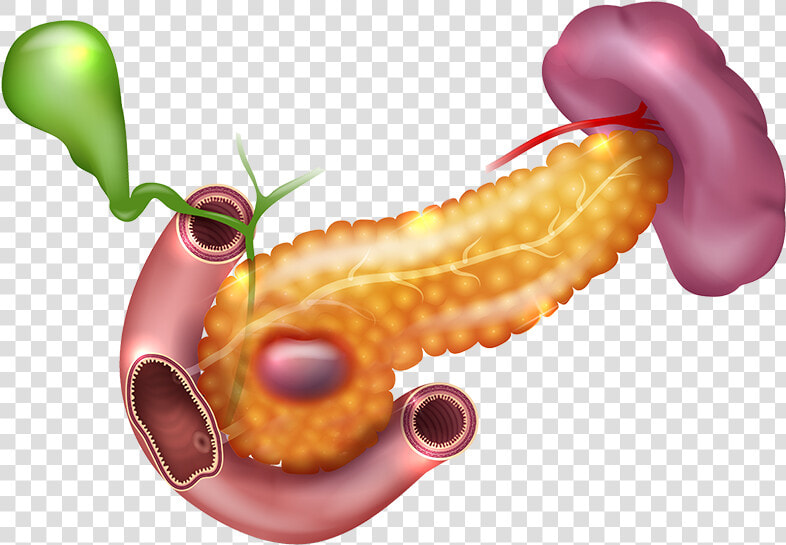 Darkspots In Pancreas   Diagram Of Pancreatic Cancer  HD Png DownloadTransparent PNG