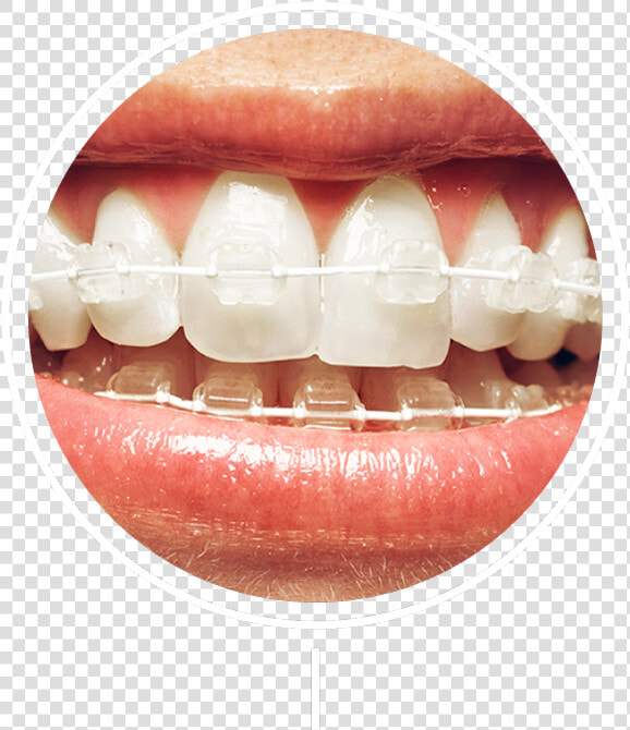 White And Silver Braces  HD Png DownloadTransparent PNG