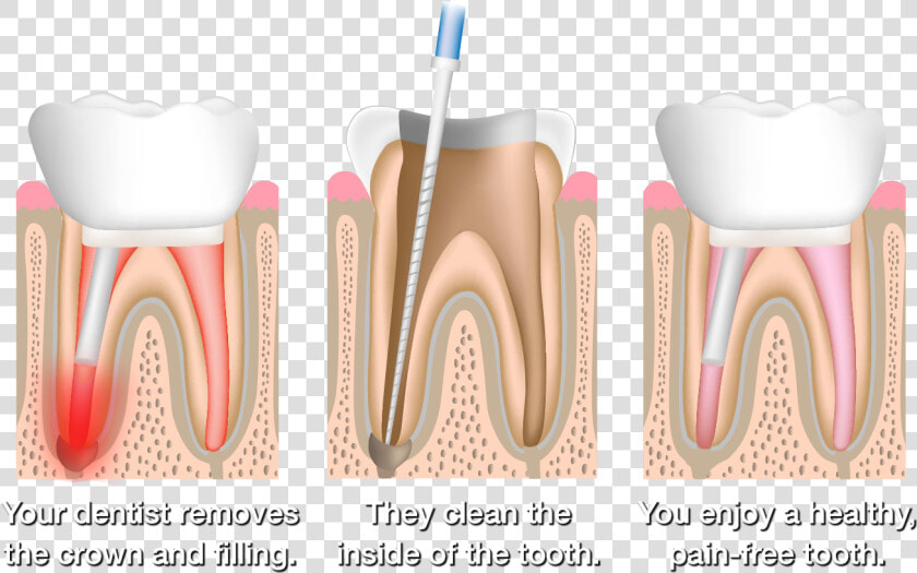 Root Canal Therapy  HD Png DownloadTransparent PNG