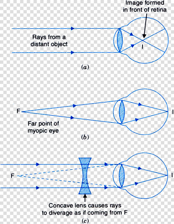 Transparent Human Eyes Png   Correction Of Myopic Eye  Png DownloadTransparent PNG