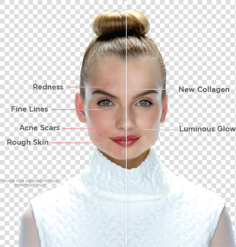 Portrait Photo With Left Side Of Face Before Treatment    Laser Facial Treatment  HD Png DownloadTransparent PNG