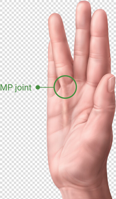 A Hand With Dupuytren’s Contracture Showing The Pip   Facts On Hand Dupuytren  39 s Contracture  HD Png DownloadTransparent PNG