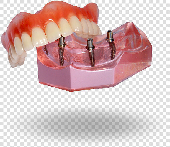 Implant Denture Model Hixson tn   Permanent Implant Dentures  HD Png DownloadTransparent PNG