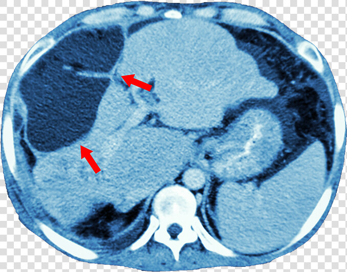 Imaging   Liver Cancer Ct Scan  HD Png DownloadTransparent PNG