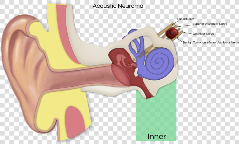 Vestibular Schwannoma Affected Nerves  HD Png DownloadTransparent PNG