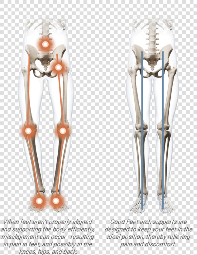 Arch Support Benefits   Orthopedic Bunion Corrector 2 0  HD Png DownloadTransparent PNG