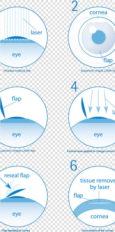 Transparent Procedure Png   Eye Laser Surgery Steps  Png DownloadTransparent PNG