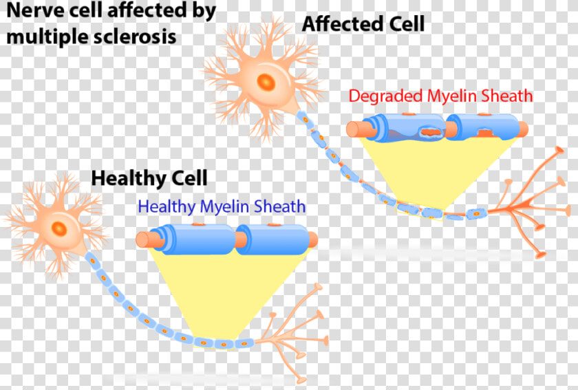 Multiple Sclerosis Nerve Cells  HD Png DownloadTransparent PNG