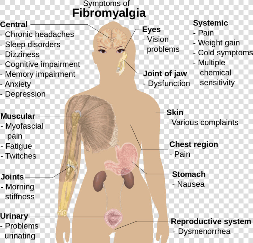 Woman Fibromyalgia Trigger Points  HD Png DownloadTransparent PNG