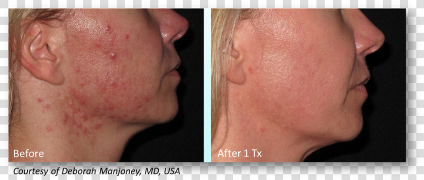 Manjoney   Infini Acne Scars Before And After  HD Png DownloadTransparent PNG