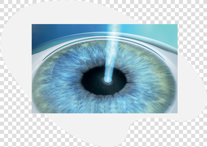 Prk Treatment With Excimer Laser   Bandage Contact Lens After Prk  HD Png DownloadTransparent PNG