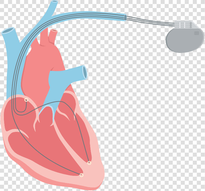 Systolic Romeo Landinez Co   Heart Failure Png  Transparent PngTransparent PNG