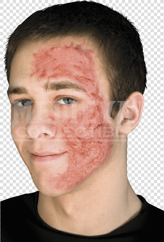 Burn Scar Face   Scar On Face From Burn  HD Png DownloadTransparent PNG