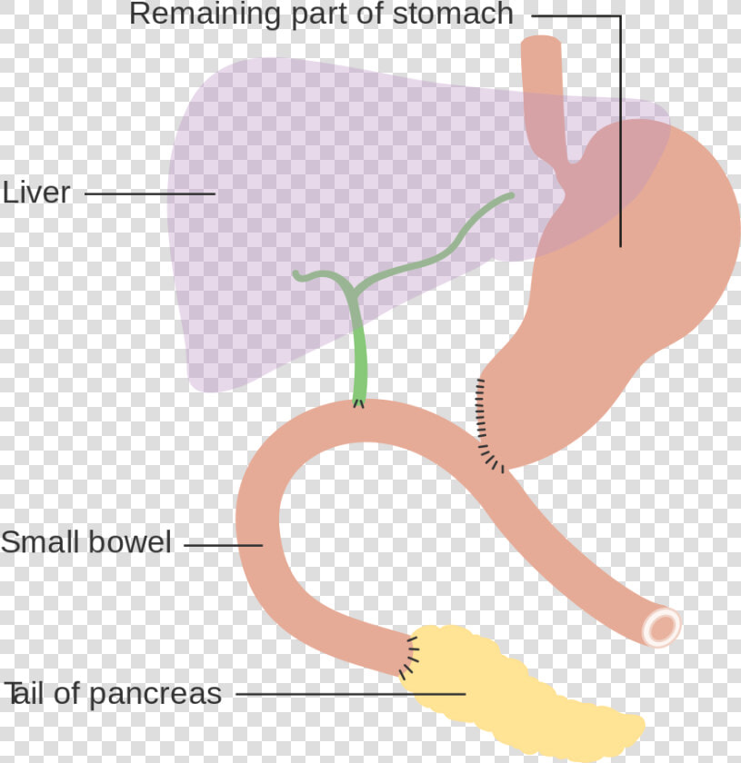 Pancreaticoduodenal Resection  HD Png DownloadTransparent PNG