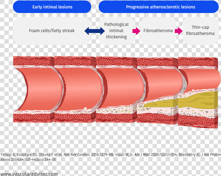 Atherosclerotic Lesion Development   Atherosclerotic Lesions  HD Png DownloadTransparent PNG