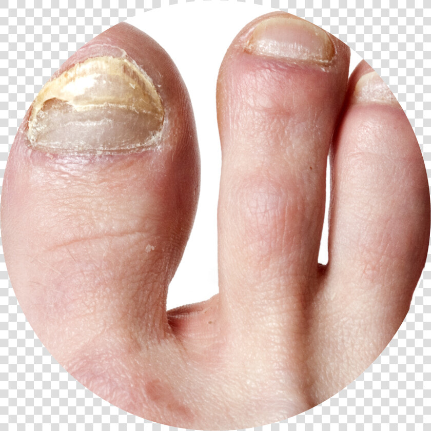 Nail Infection Circle   Грибок На Ногтях Ног  HD Png DownloadTransparent PNG