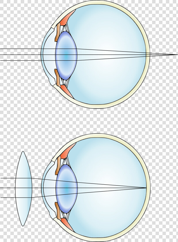 Hypermetropia And Correction   Convex Lens Uses  HD Png DownloadTransparent PNG