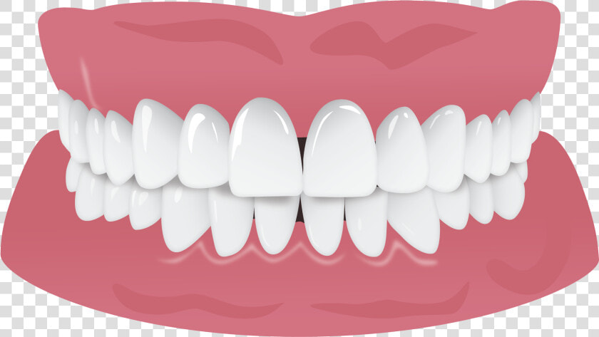 Invisalign Gap Teeth Missing Tooth  HD Png DownloadTransparent PNG