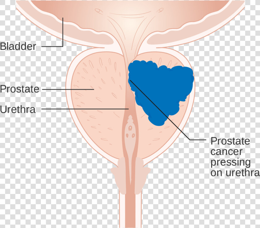 Prostate Cancer Diagram Class Img Responsive Lazyload  HD Png DownloadTransparent PNG