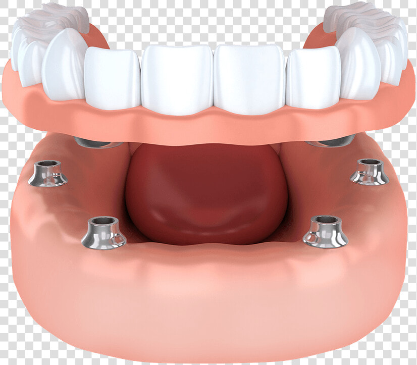 Implant Supported Model Brownstown  Mi   Snap Dentures  HD Png DownloadTransparent PNG