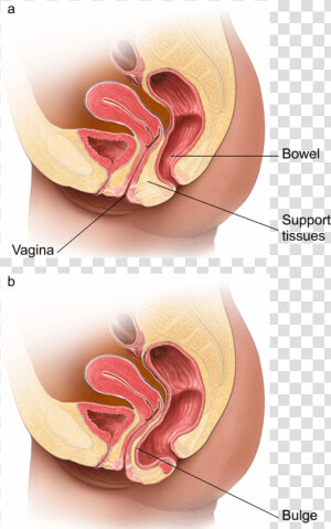 Illustration Showing A Normal Vagina And One With A   Posterior Prolapse  HD Png Download