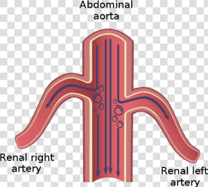 Turbulence In Abdominal Aorta Aneurisma   Aorta Addominale E Arteria Renale  HD Png Download